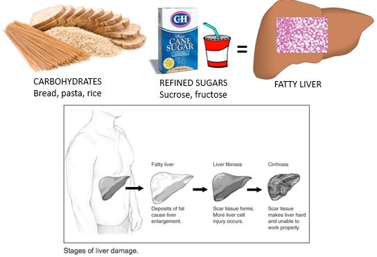 Stages of Liver Damage