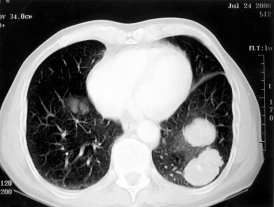 lung-ct-1