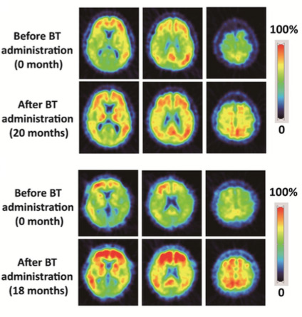 Brain scans: Before And After BenfoThiamine