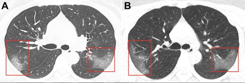 Lung scan: gound-glass opacities