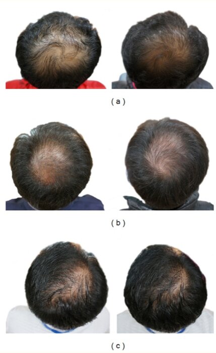 Hair loss - comparison