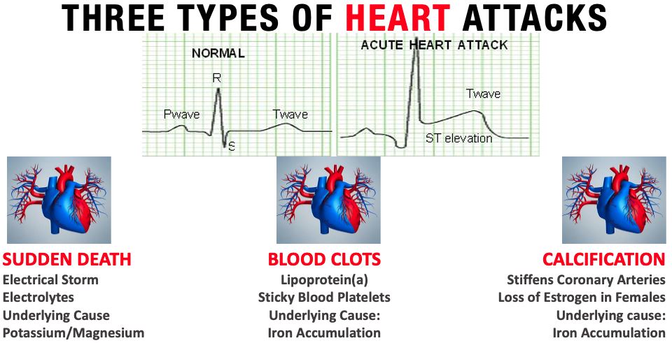 3 types of Heart Attack