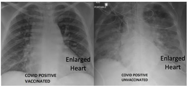 X-ray: comparison vaccinated vs unvaccinated