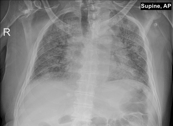 X-ray: Covid-19 Pneumonia