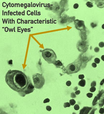 Cytomegalovirus infected cells