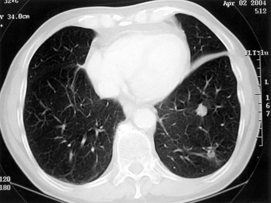 lung-ct-2